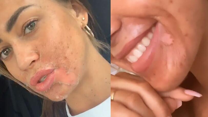 Die Haut spannt und löst sich in Fetzen ab! Was ist denn da bei Jessica Paszka los? Die Haut spannt und löst sich in Fetzen ab! Was ist denn da bei Jessica Paszka los?