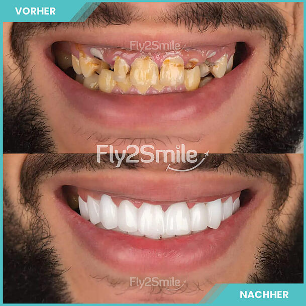 Die Kraft des Lächelns neu entdecken! Beeindruckende Vorher-Nachher-Ergebnisse. Die Kraft des Lächelns neu entdecken! Beeindruckende Vorher-Nachher-Ergebnisse.