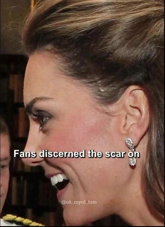 Hier deutlich zu sehen: Prinzessin Kate hat eine lange Narbe über dem linken Ohr.