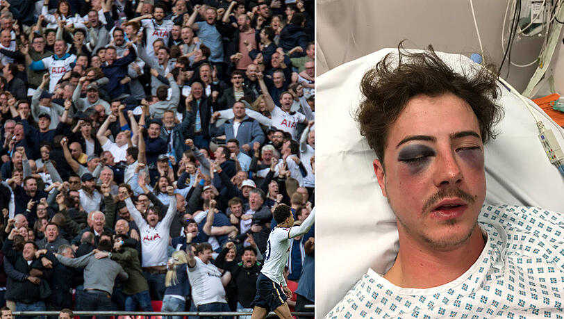 Tottenham-Hooligans haben Michael Vollmer ordentlich zugerichtet. Tottenham-Hooligans haben Michael Vollmer ordentlich zugerichtet.