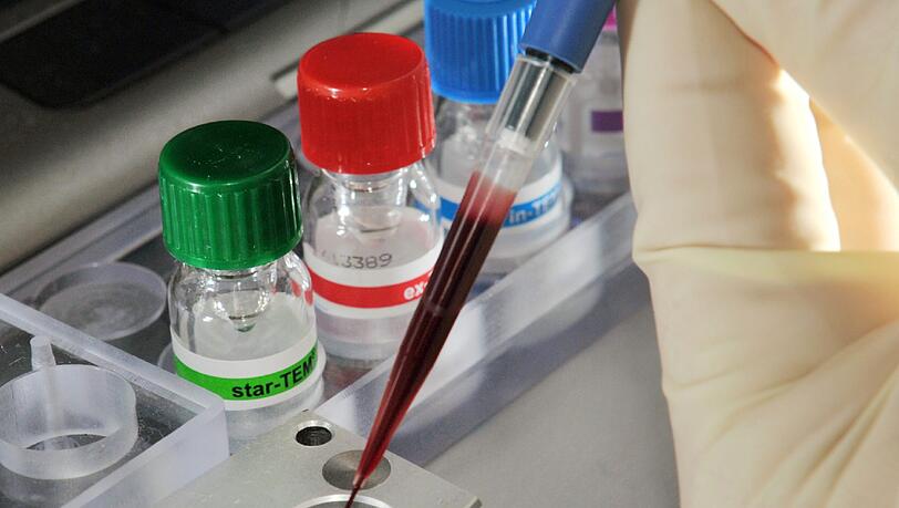 Sepsis (Blutvergiftung) ist weltweit eine häufige Todesursache. In Industrienationen steigt die Zahl der Erkrankungen seit Jahren wieder an. Foto: Jan-Peter Kasper/Archiv Sepsis (Blutvergiftung) ist weltweit eine häufige Todesursache. In Industrienationen steigt die Zahl der Erkrankungen seit Jahren wieder an. Foto: Jan-Peter Kasper/Archiv