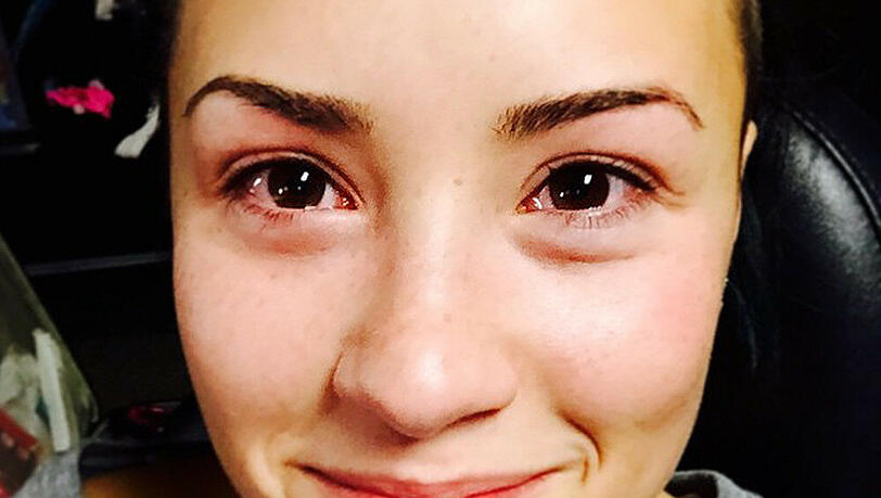 Demi Lovato leidet unter einer Katzenallergie Demi Lovato leidet unter einer Katzenallergie